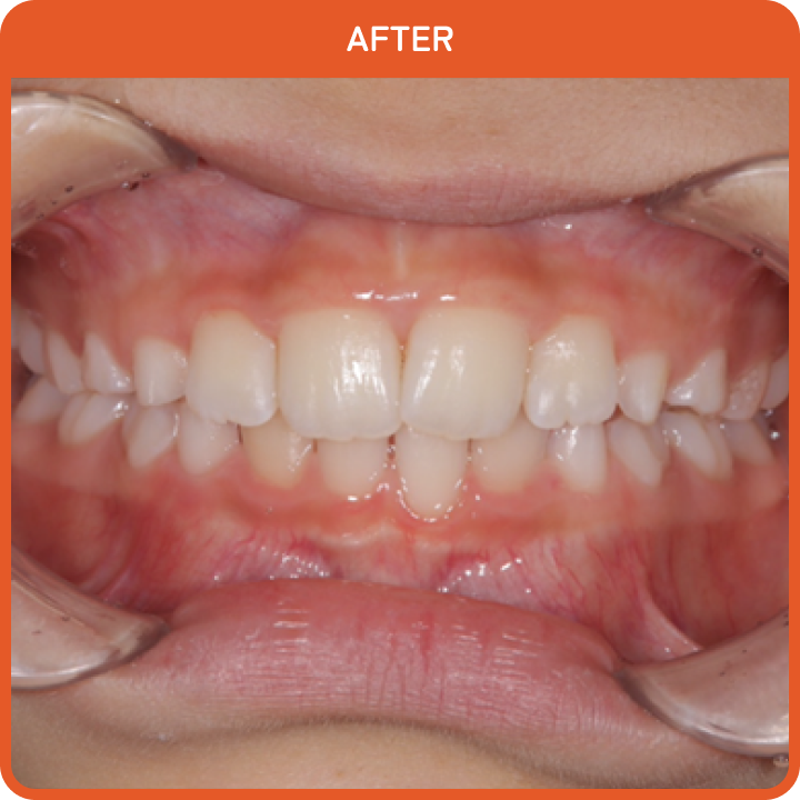 治療後の歯並び1