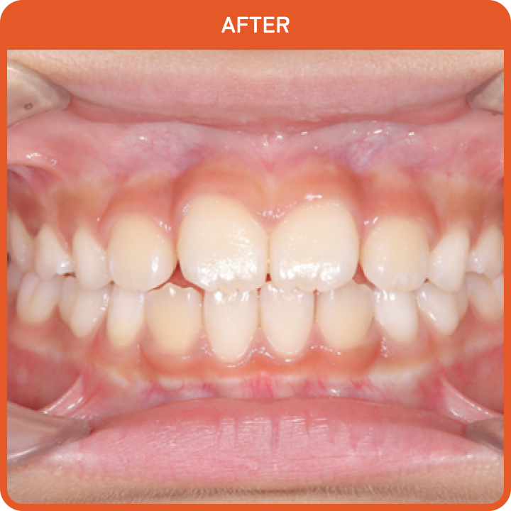 治療後の歯並び2