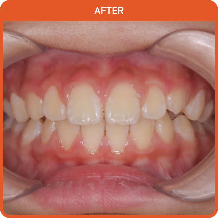 治療後の歯並び3