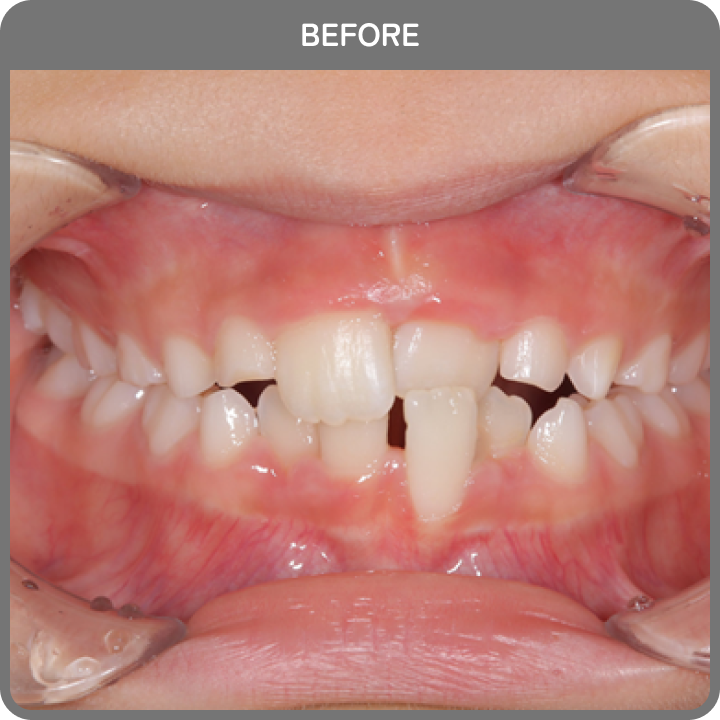 治療前の歯並び1