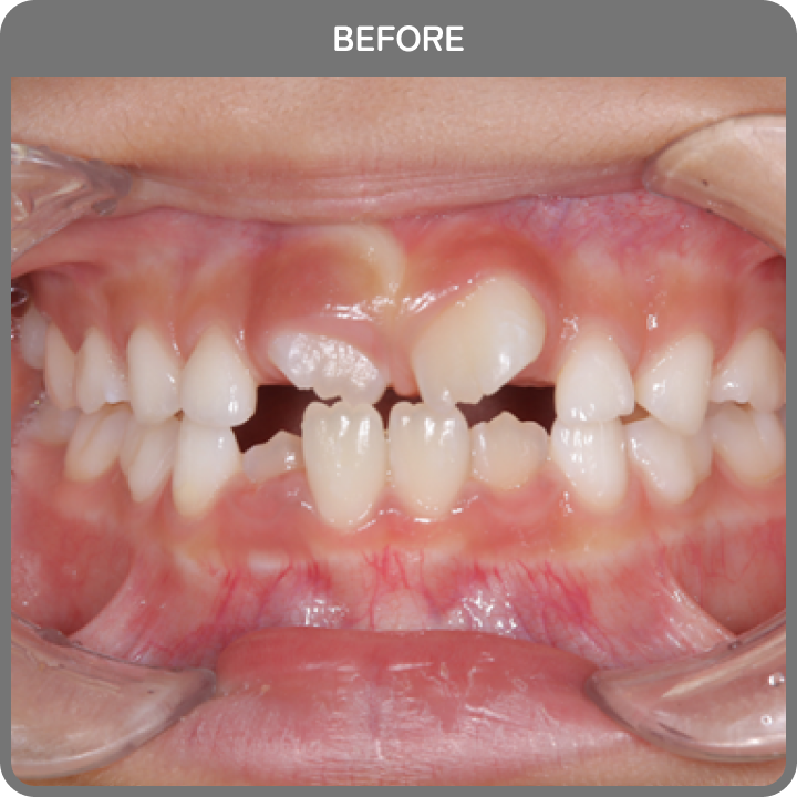 治療前の歯並び2