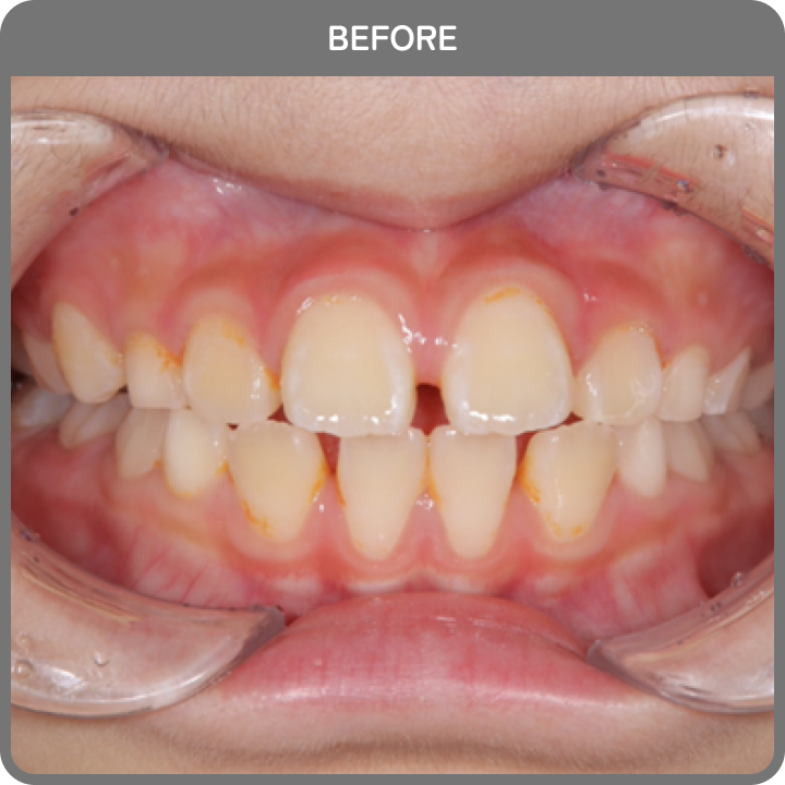 治療前の歯並び3