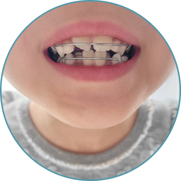 ブラケット矯正をしているお子さま